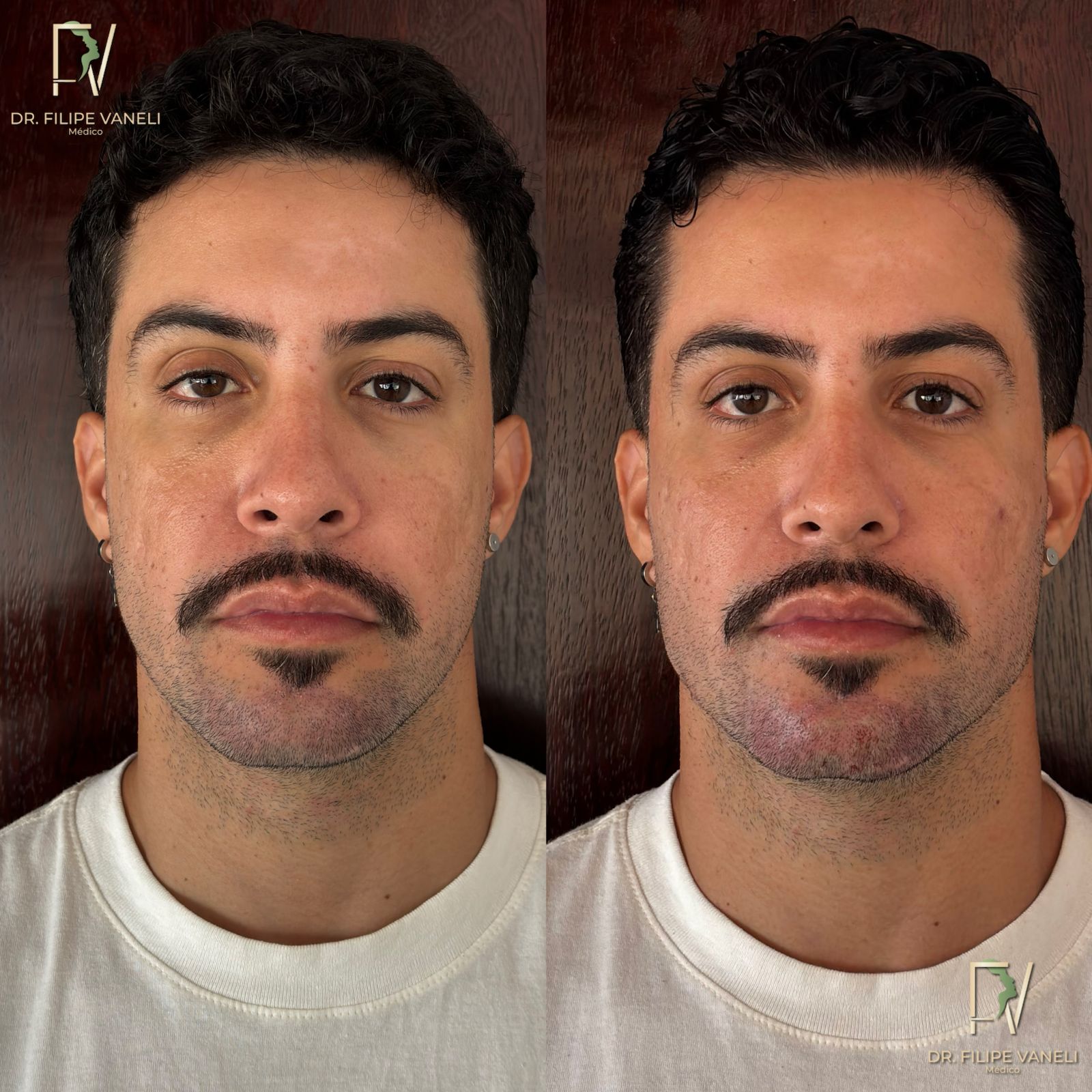 Resultado Facial 1
