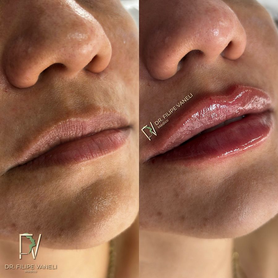 Resultado Labial 4