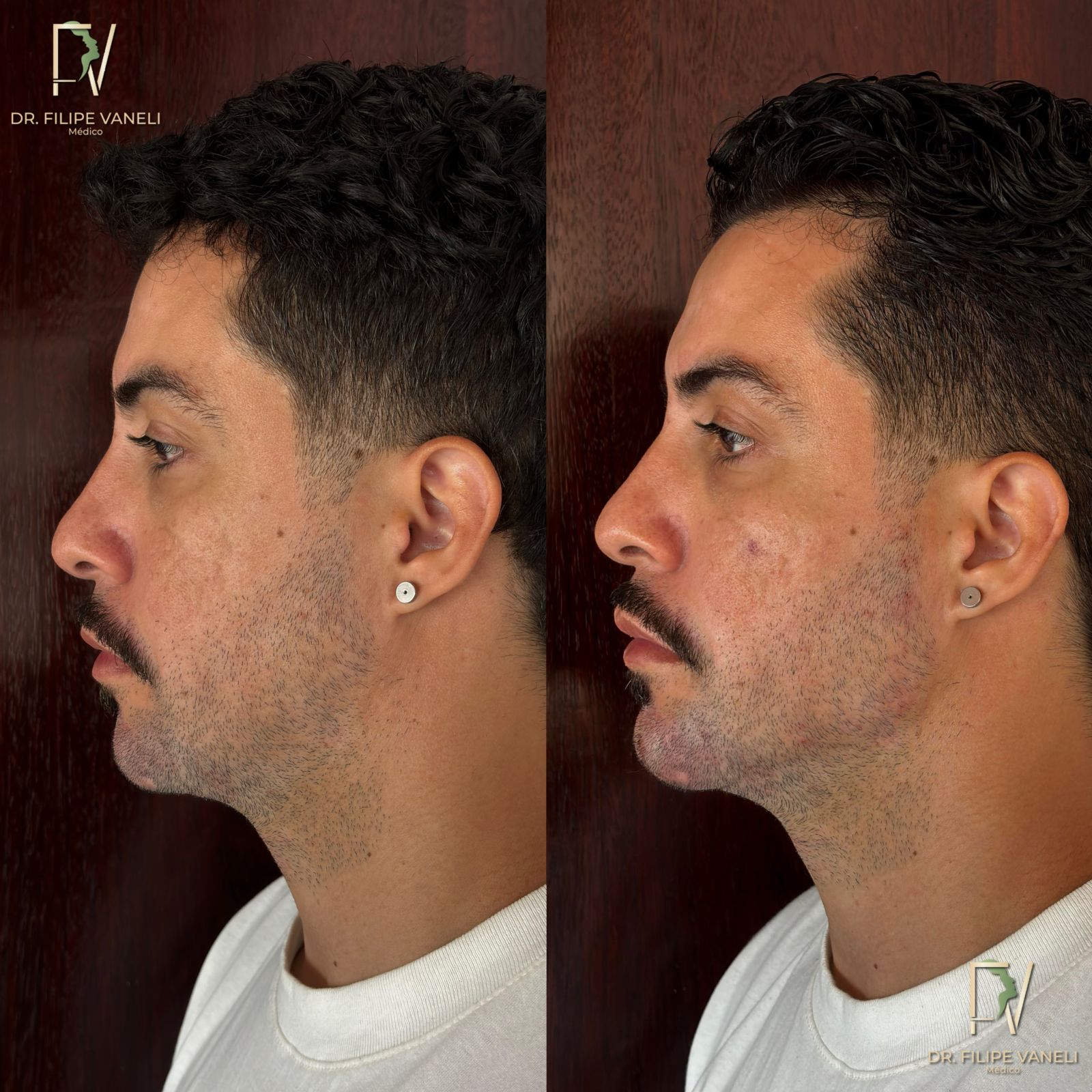 Resultado Facial 2