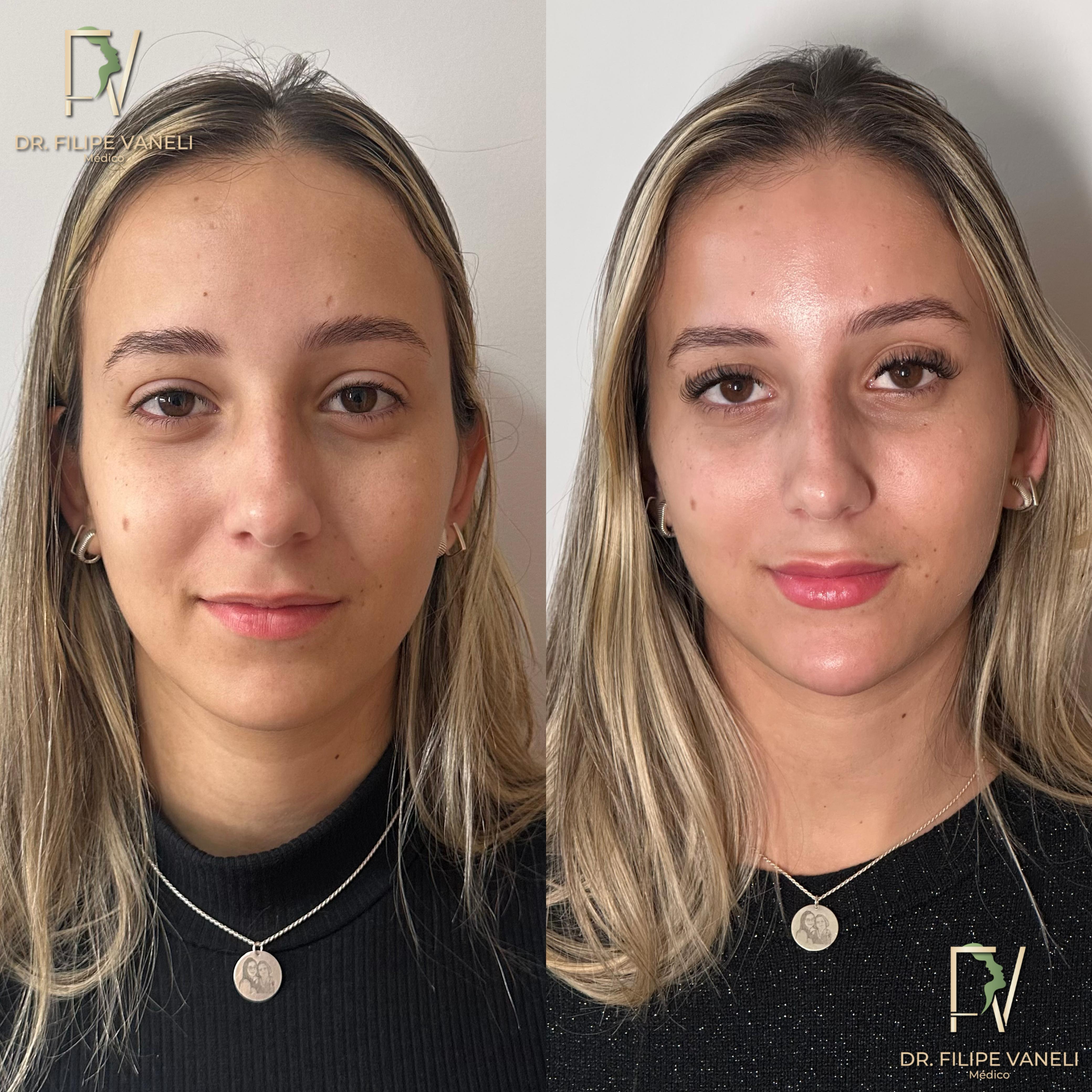 Resultado Corporal 5