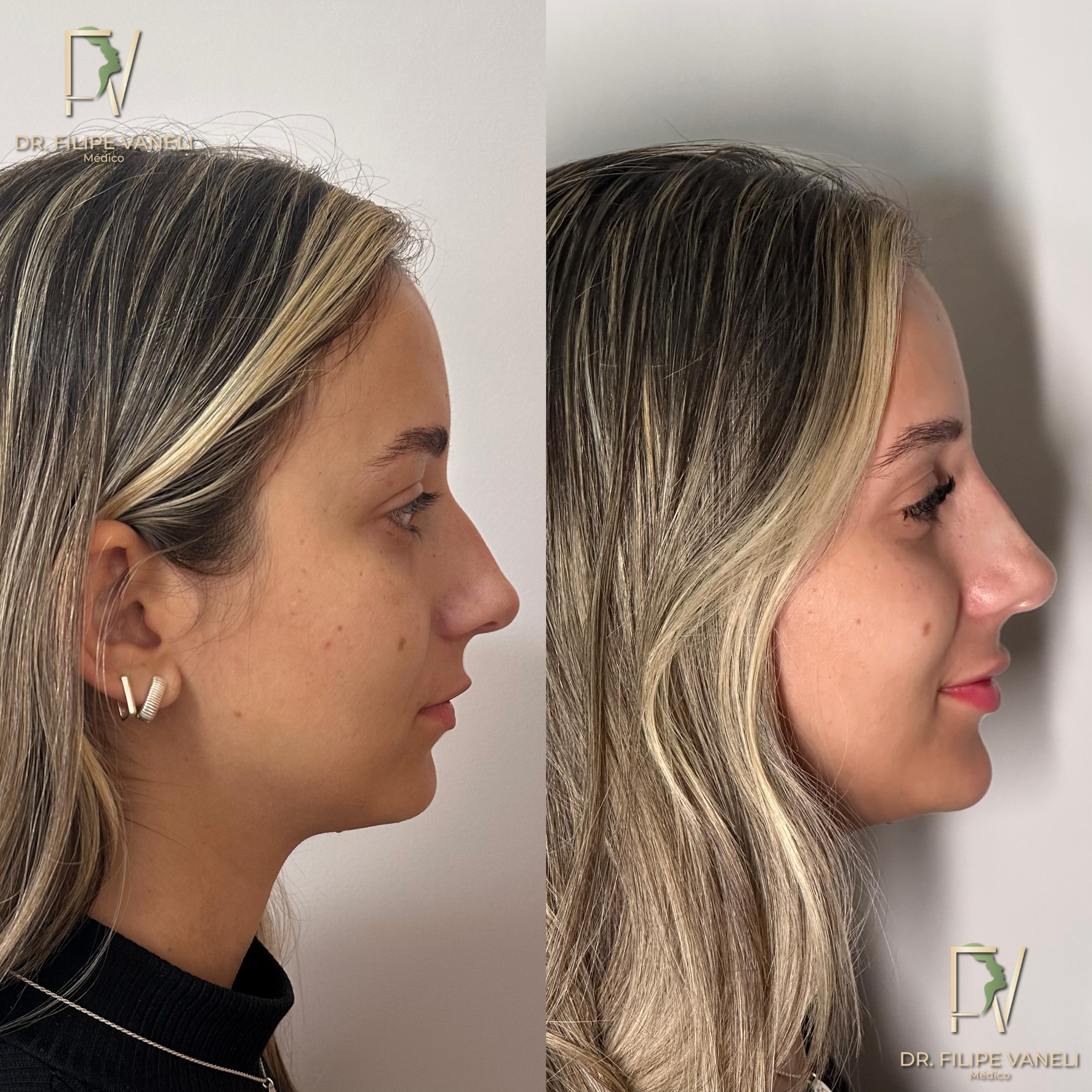 Resultado Corporal 5