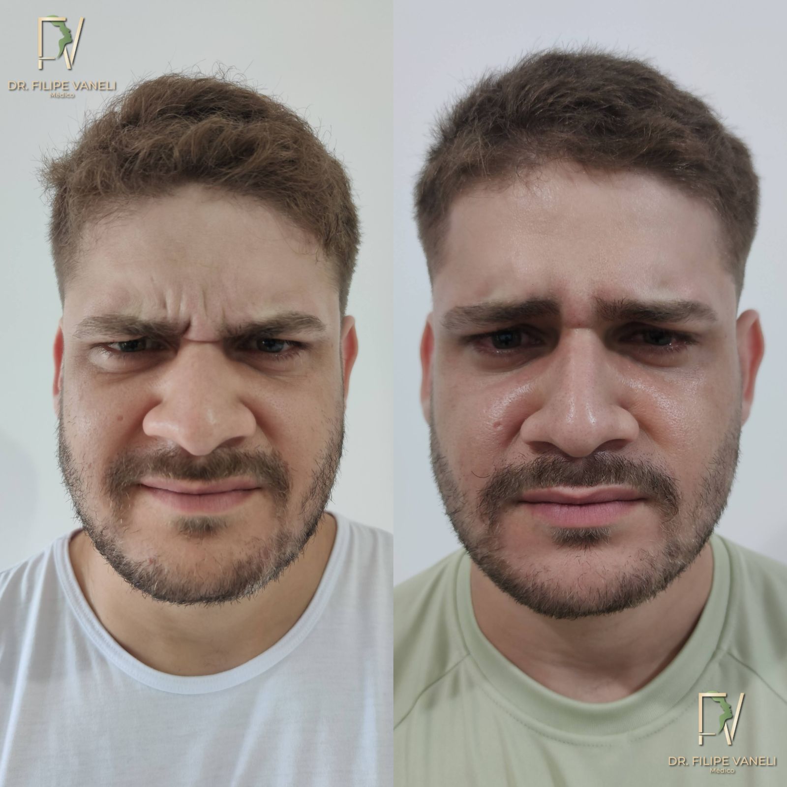 Resultado Facial 3