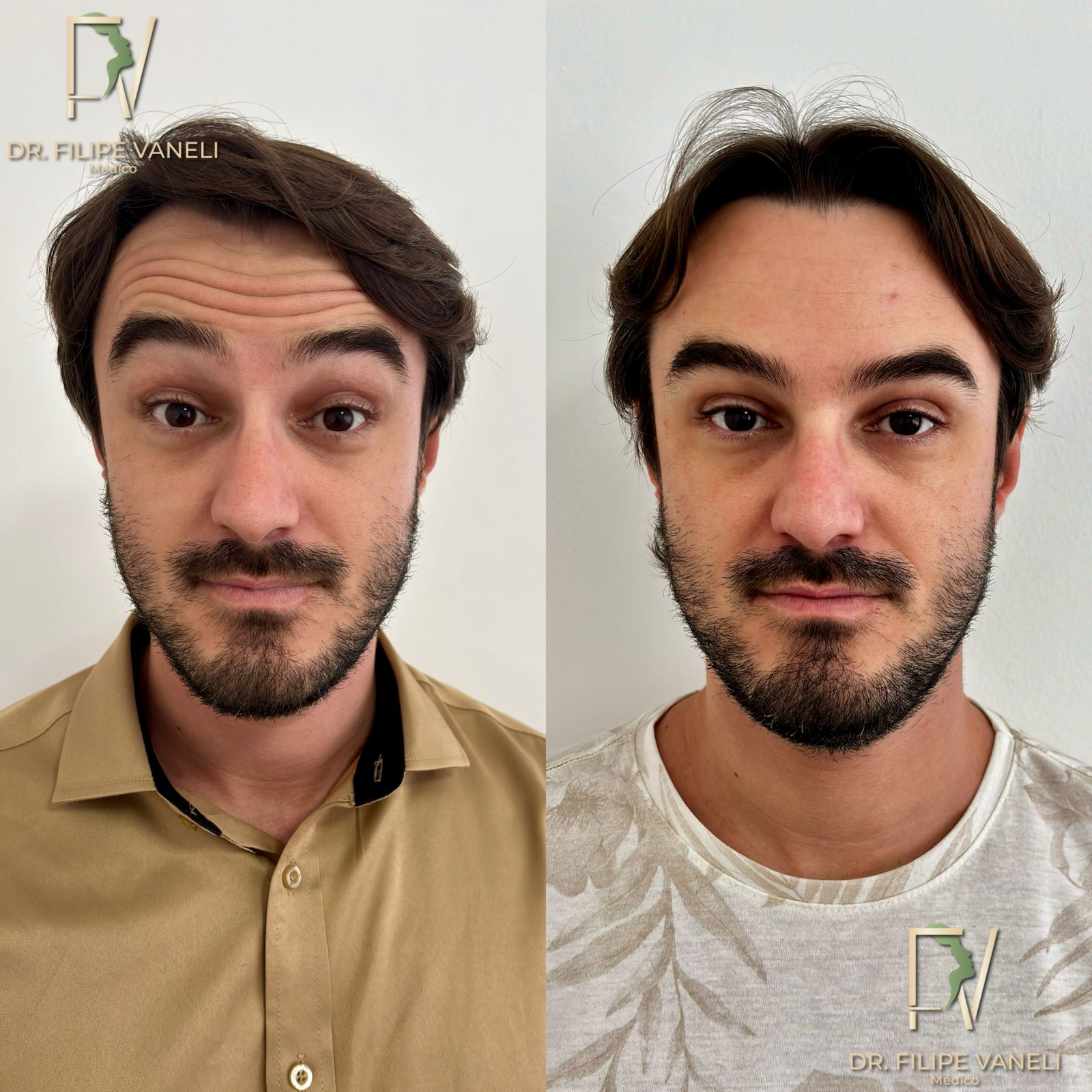 Resultado Facial 4