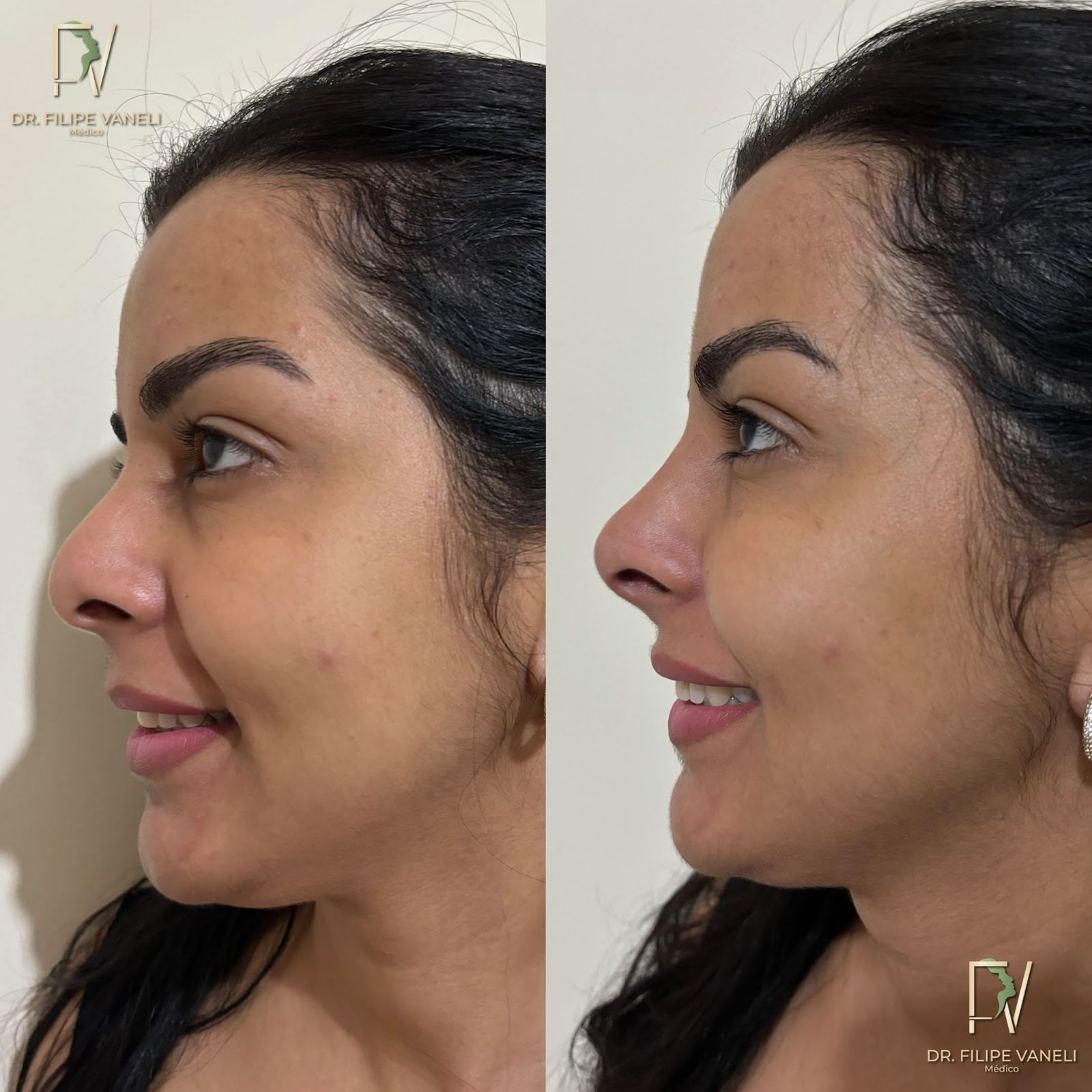 Resultado Corporal 3