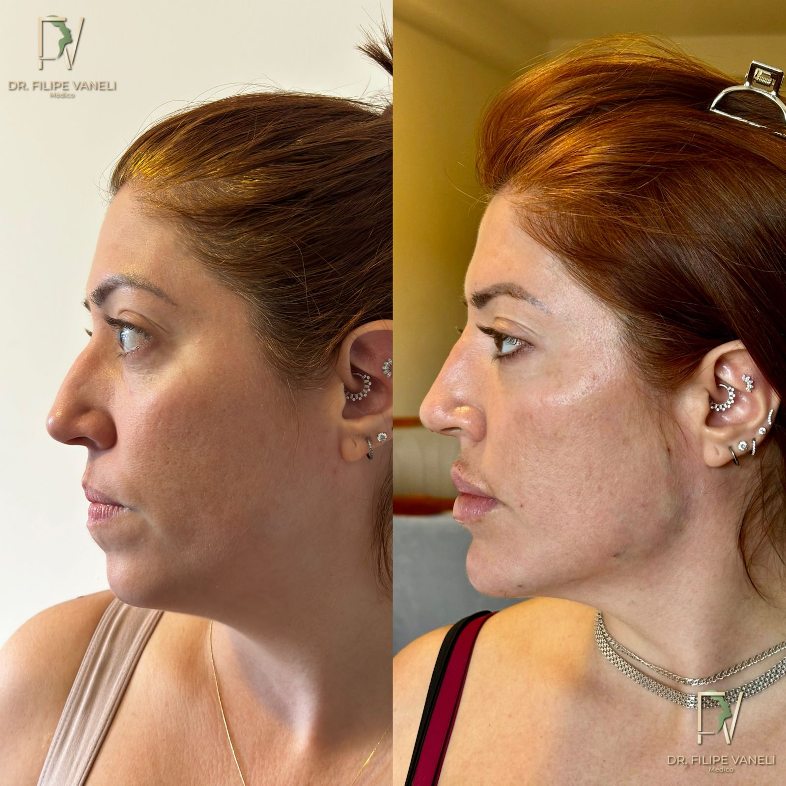 Resultado Corporal 4